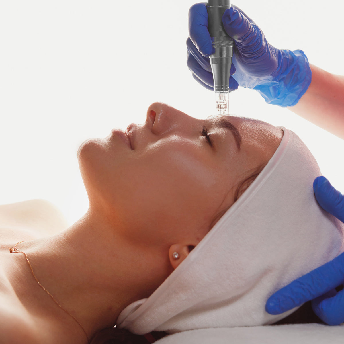 6x Skin Needling Treatments - Skin Deep Rebuild